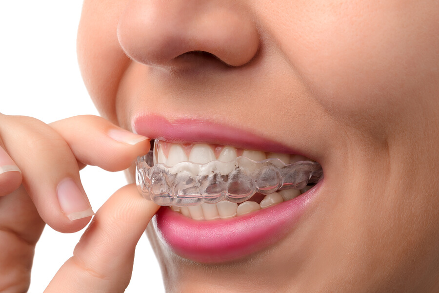 How does Invisalign Work?