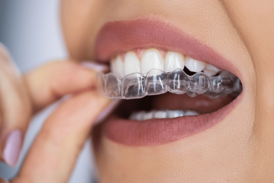 Retainers for Teeth Straightening