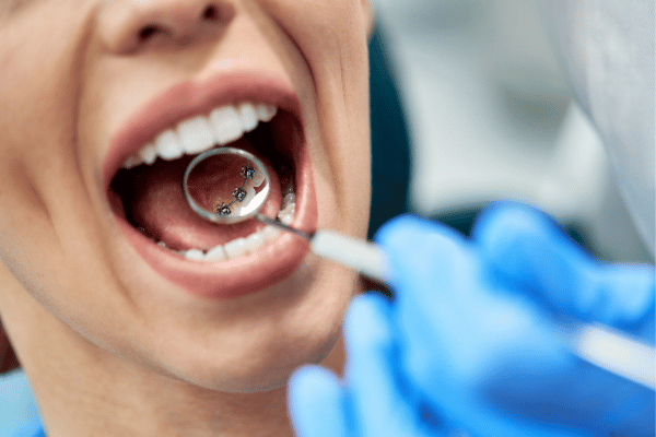 lingual braces for teeth straightening