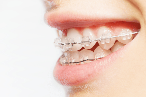 ceramic braces for teeth straightening