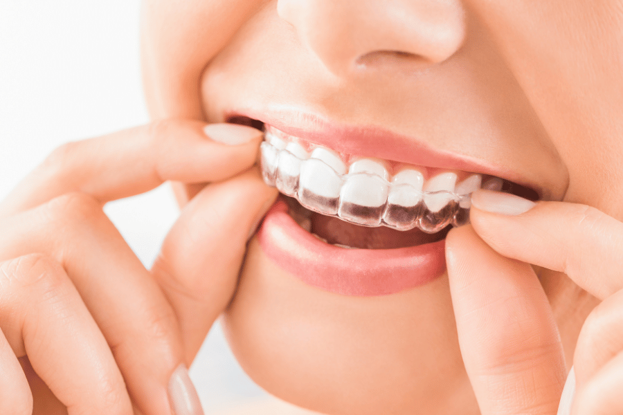 Woman wearing clear aligners