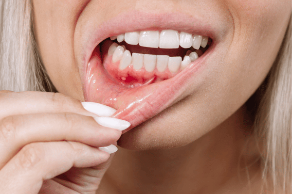 gum inflammation