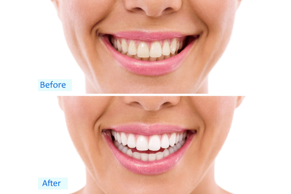 teeth whitening before and after