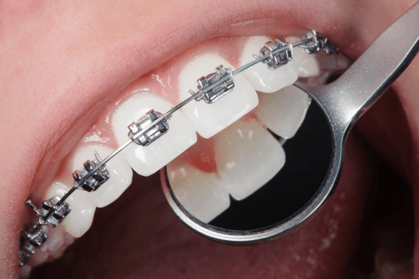 Lingual Braces