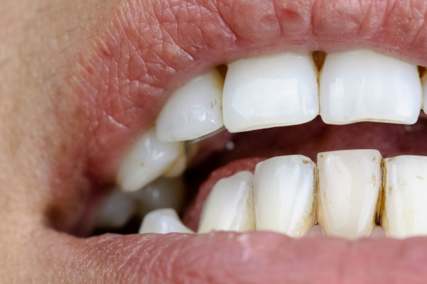 Heavily Stained Yellow Teeth