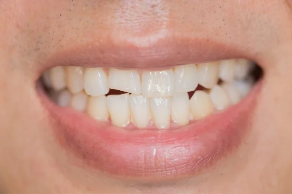 A close-up capturing chipped teeth